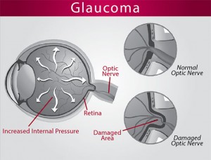 How is glaucoma diagnosed?