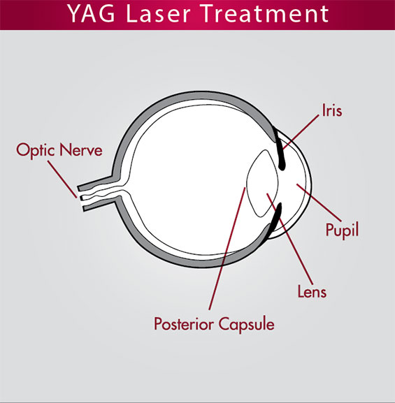 YAG Laser Knoxville Cataract Surgery Farragut Posterior Capsulotomy