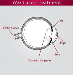 YAG Laser Treatment