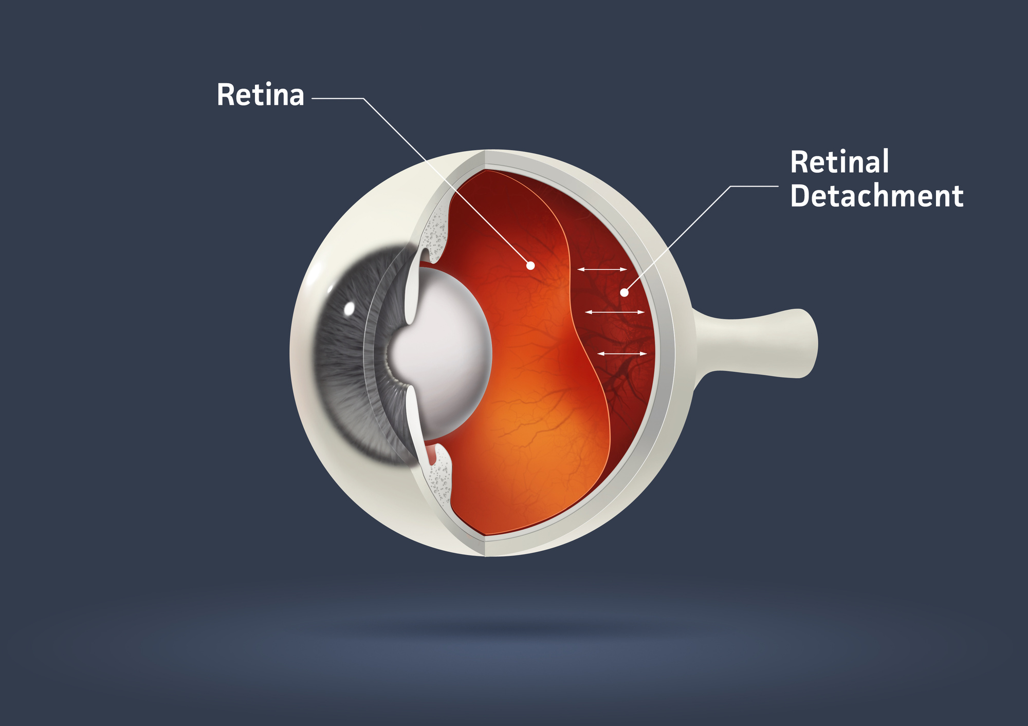 The Top Signs You Have Retinal Detachment Drs Campbell Cunningham Taylor And Haun