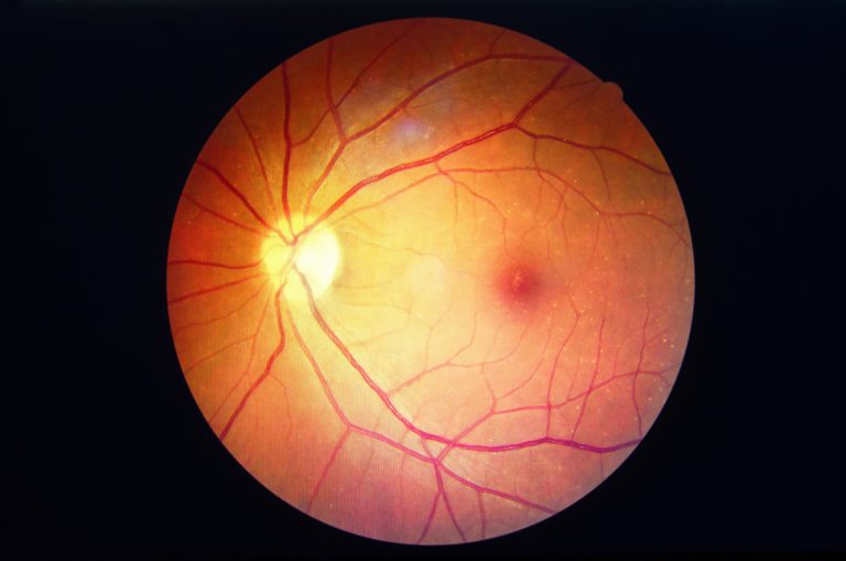 What Is A Macular Hole And How Does It Affect Your Vision Drs 