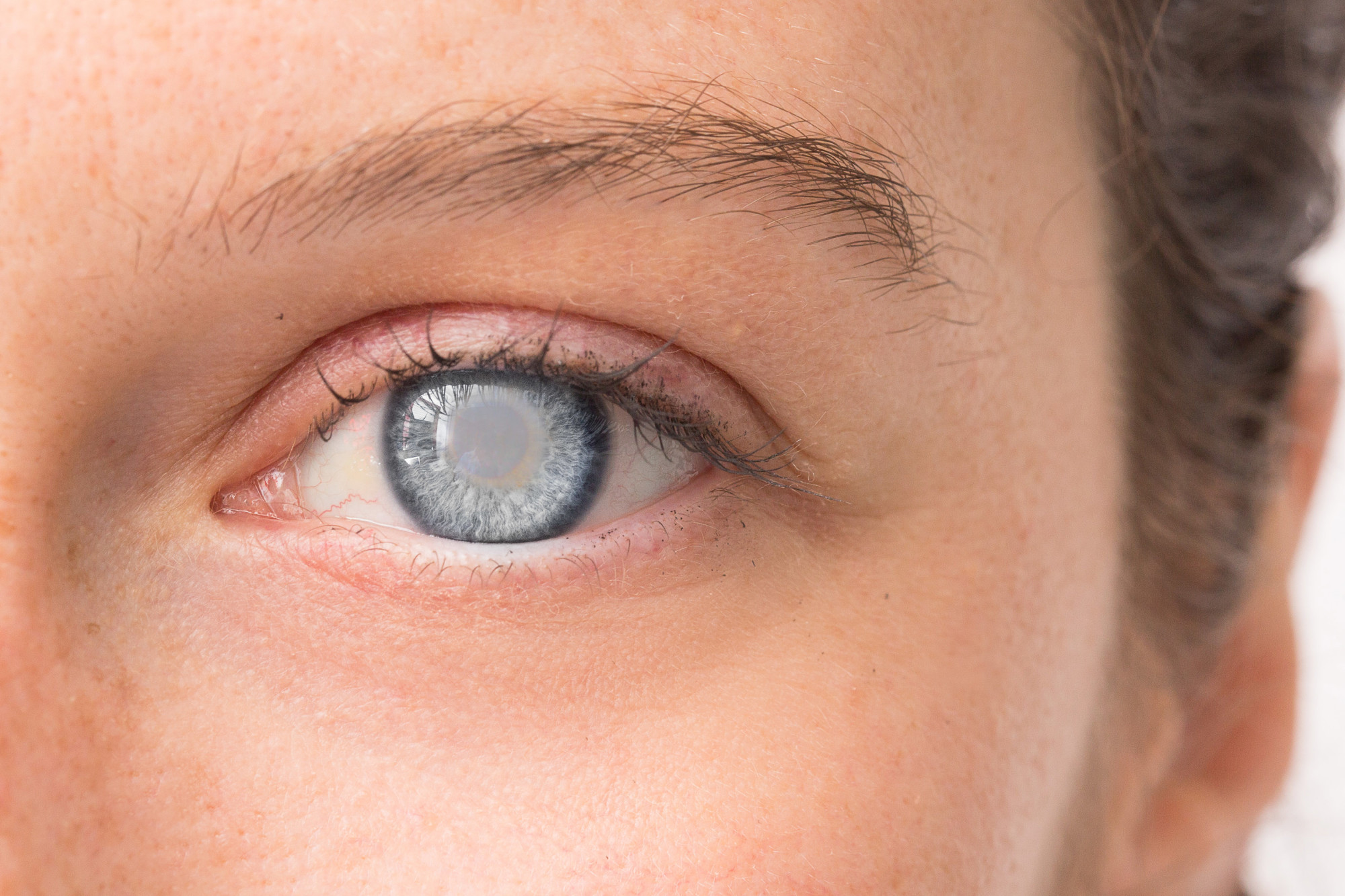Diagnosis And Treatment Of Cataracts Your Flexible Health